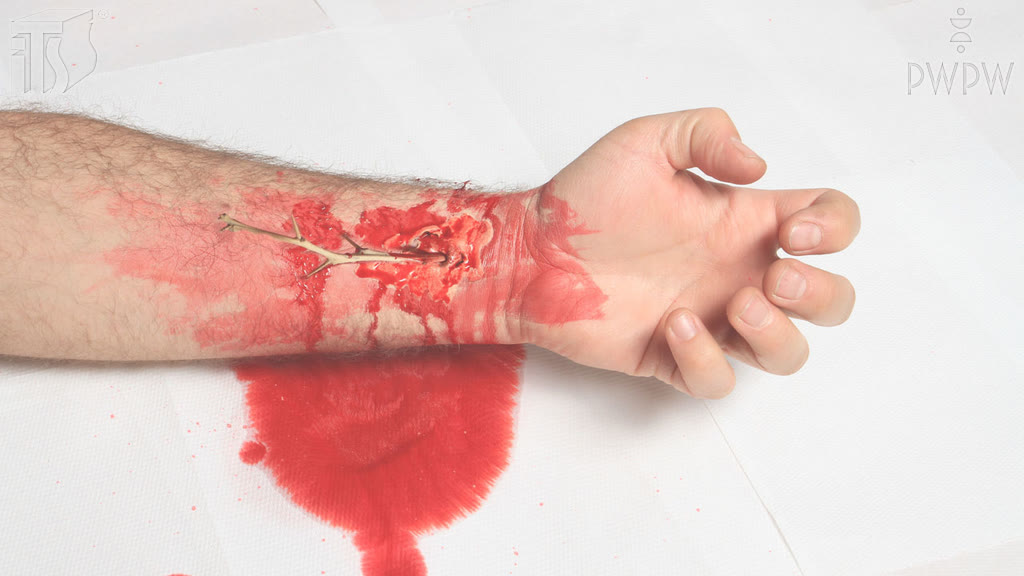 Question illustration: What should you do if some foreign matter has impaled itself into a passenger's forearm?